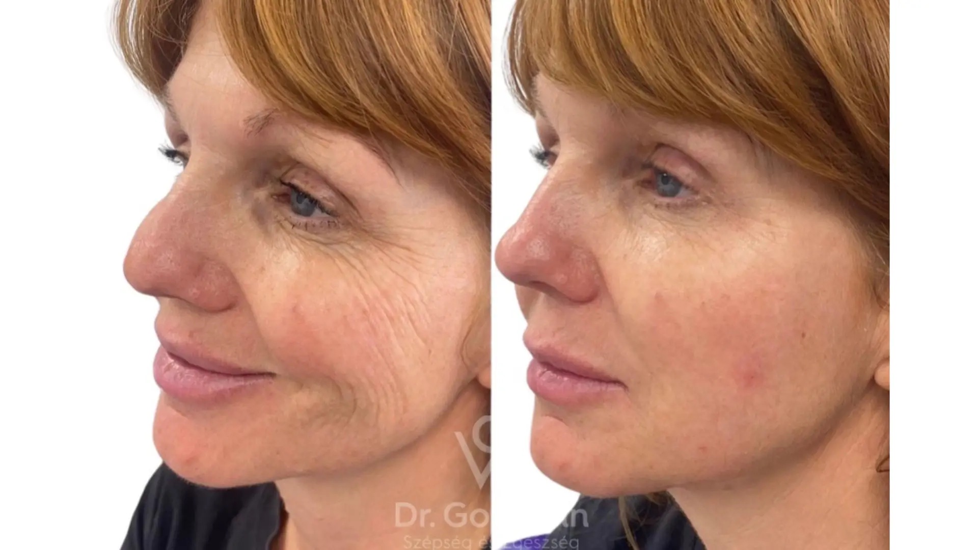 EJAL 40 előtte-utána 2